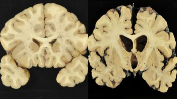 CTE brain scan